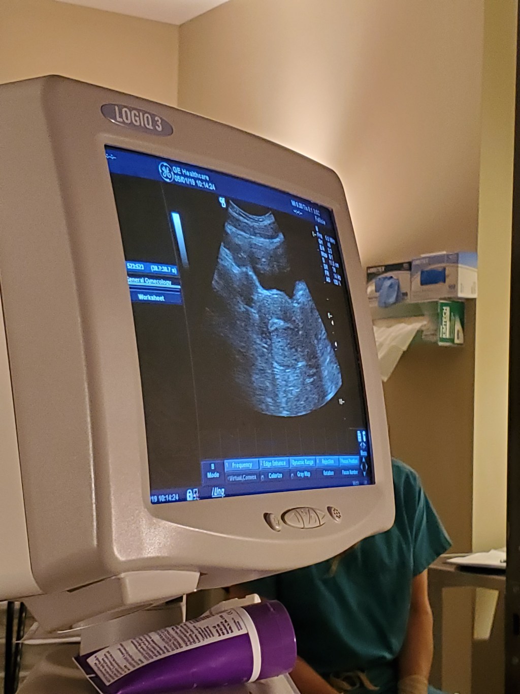 Surrogacy :DAY OF&nbsp;IMPLANTATION